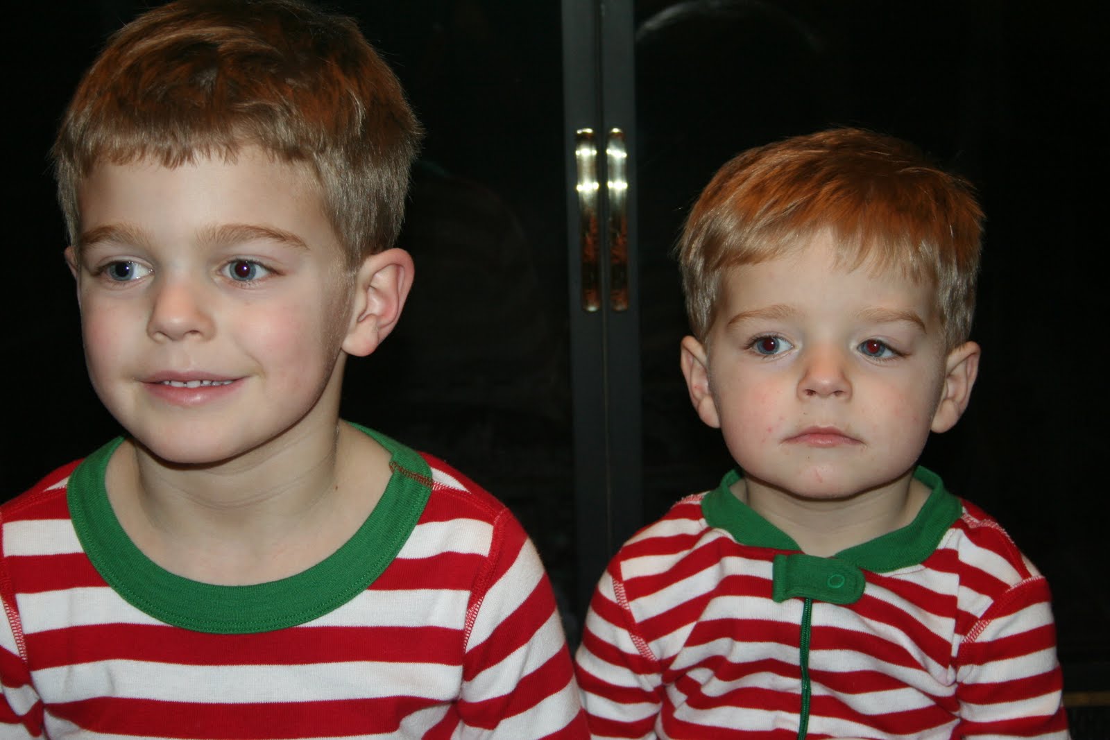 Congenital Ptosis Photos 12+ months after frontalis sling surgery