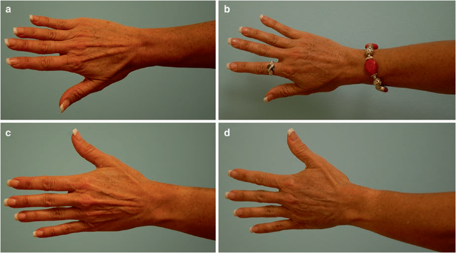 Plastic and Reconstructive Surgery Treatment of Hand Atrophy with Fat