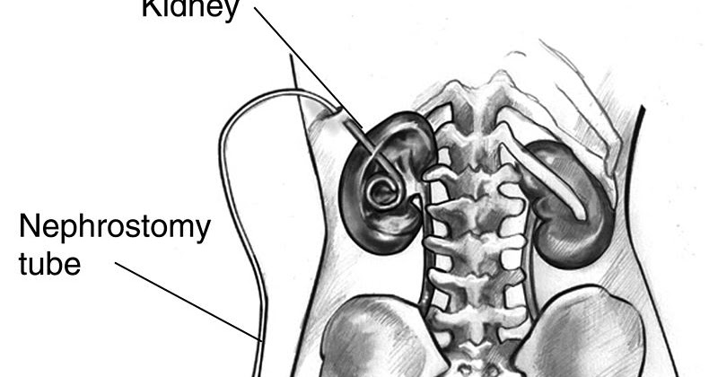 nephrostomy does