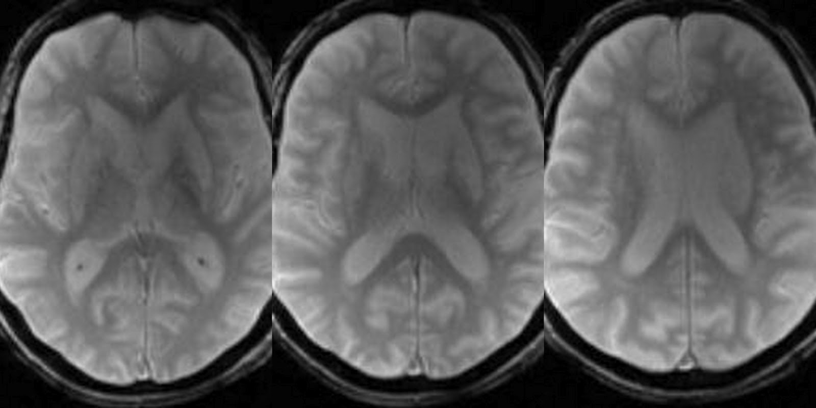 Dr Balaji Anvekar FRCR UL Basal ganglia T1 hyperintensity