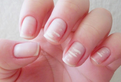 Los tratamientos del hongo de las uñas por la lámpara de cuarzo
