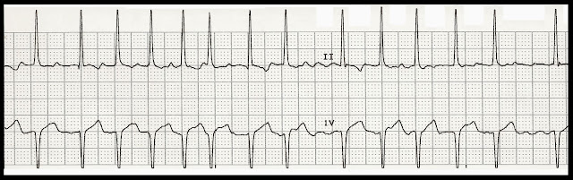 Float Nurse: EKG Rhythm Strip Quiz 186