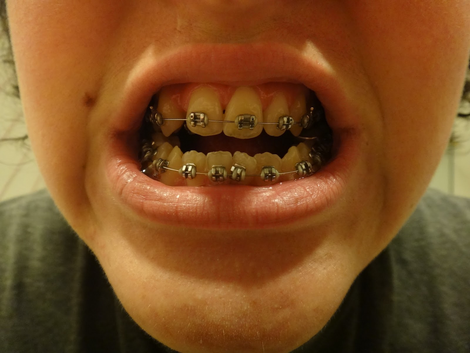 Kelsie's Jaw Surgery First Braces Tightening