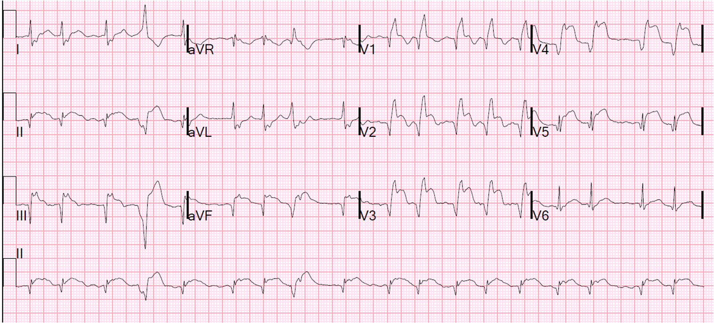 Dr  Smith U0026 39 S Ecg Blog  Large Transmural Stemi With