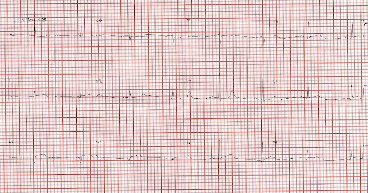 45+ V3R V4R Ecg Gif