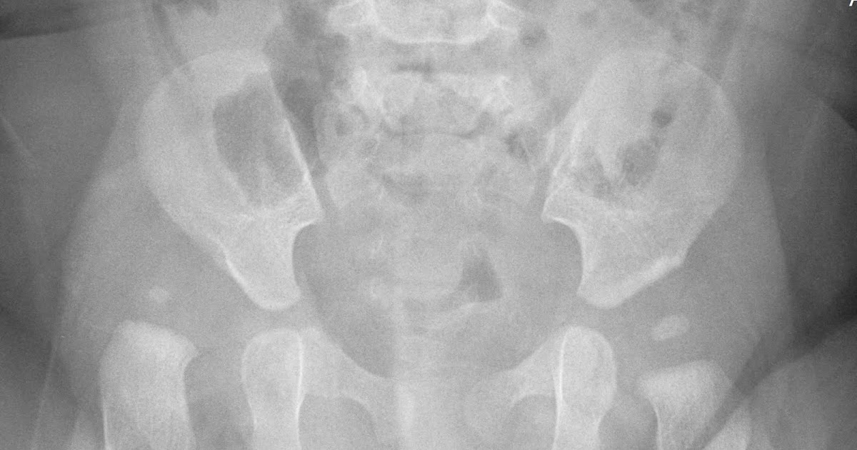 Our Sweet Ev Developmental Dysplasia of the Hip