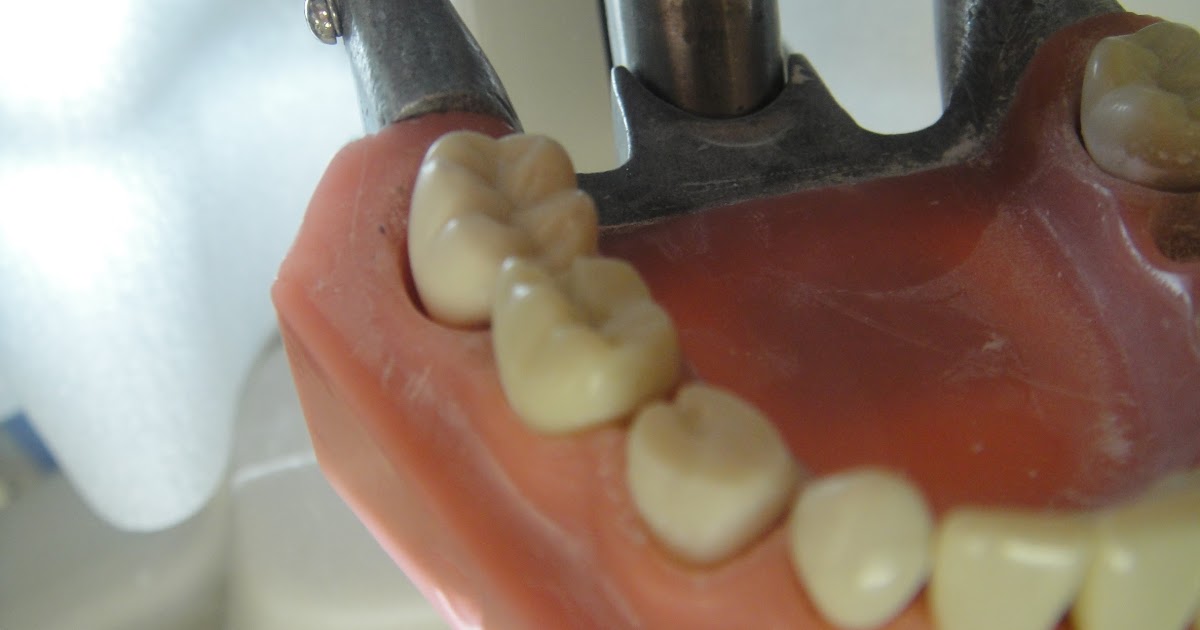 StuDENT Diaries Pedo Stainless Steel Crown