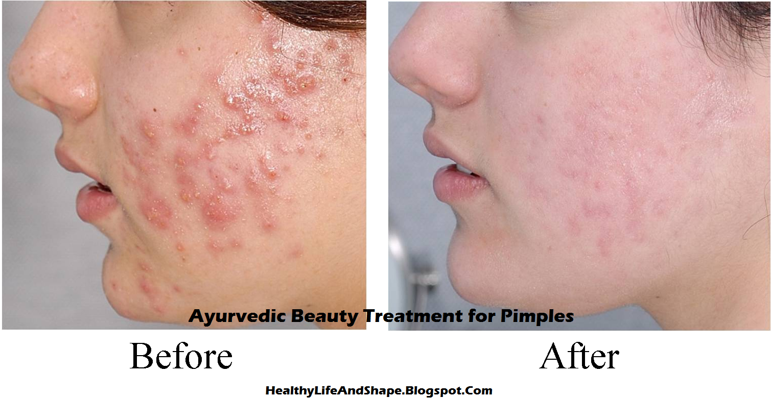 Ayurvedic Beauty Treatment for Pimples Healthy Life and Shape