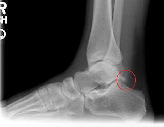 Little Bone, Big Problems: Funny Bone