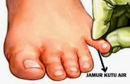 ramuan tradisional (herbal) mengobati penyakit kulit kutu air (rangen) dengan cepat