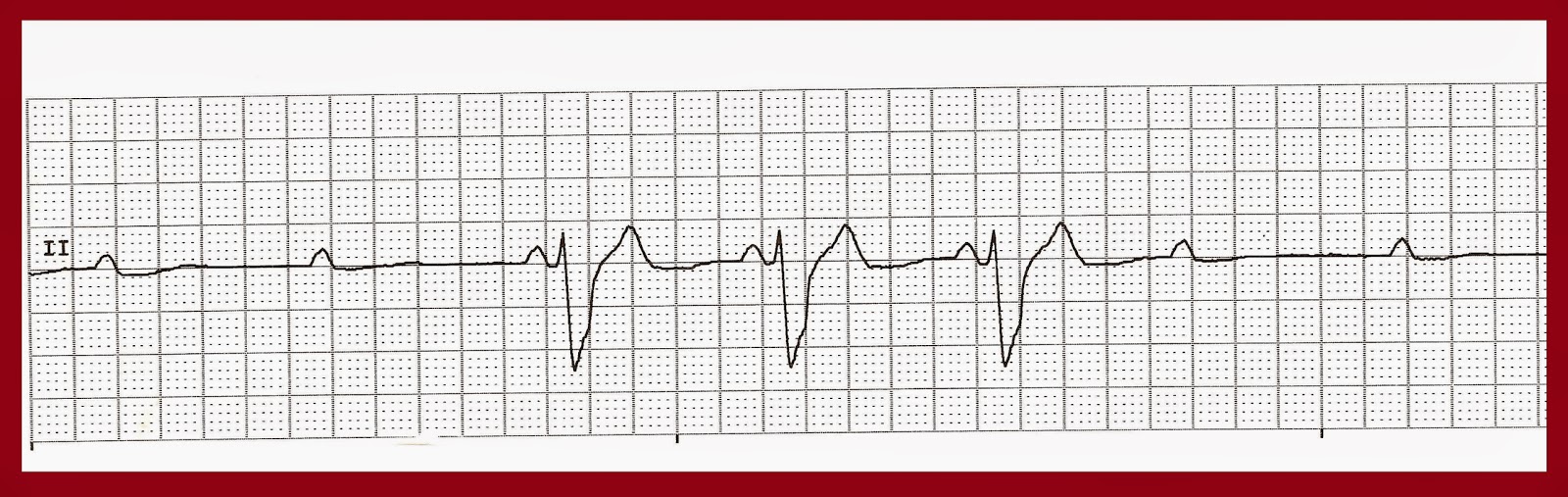 Float Nurse Practice EKG Strips 337