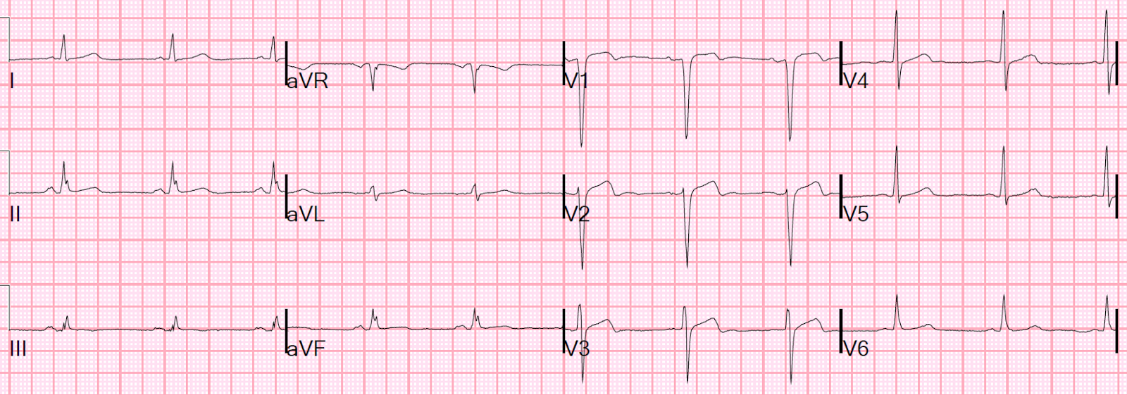 Serial Ecg Frequency Serial Ecg Frequency