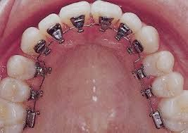 http://dentistinchennai.com/braces.php