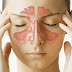 Sinusitis, Natural Remedies and Health Tips