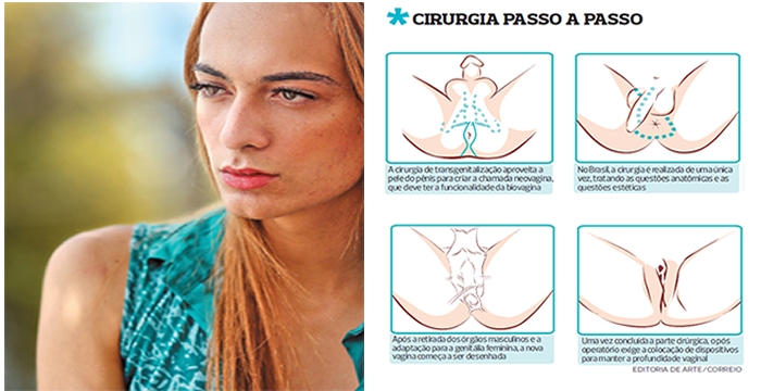 Resultado de imagem para mudança de sexo cirurgia