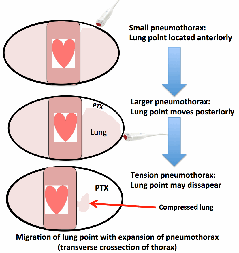 HydroPoint Ultrasound sign of airfluid level in the pleura