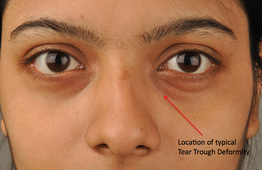 Image result for tear trough deformity