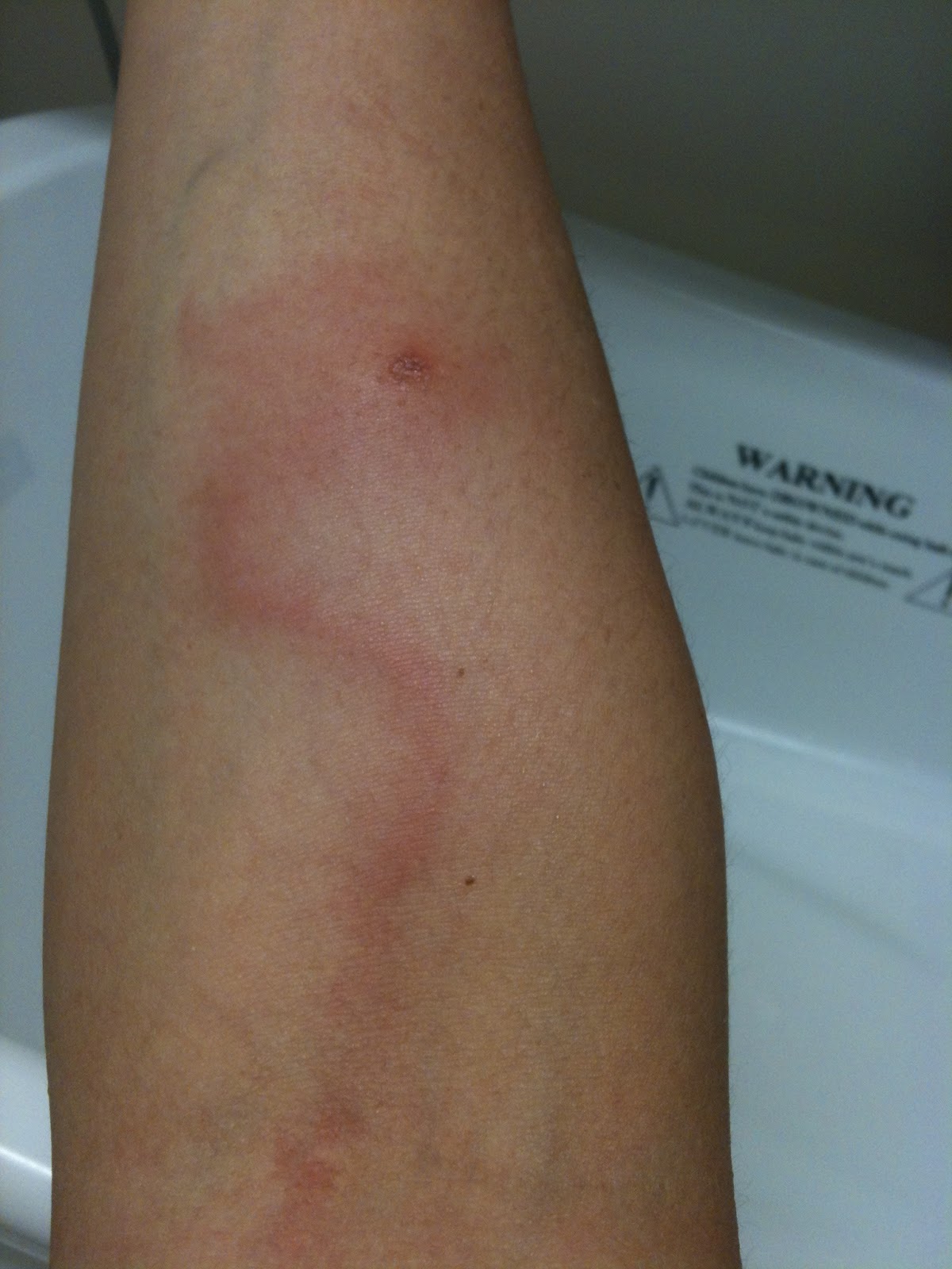 Swollen Spider Bites On Arm