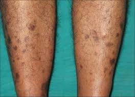 diabetic dermopathy treatment diabetic dermopathy treatment