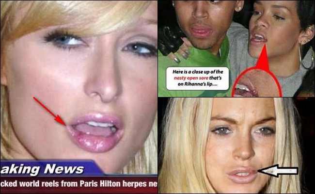 10 Selebritis Wanita yang terkena Penyakit Virus Menular 10 Selebritis Wanita yang terkena Penyakit Virus Menular