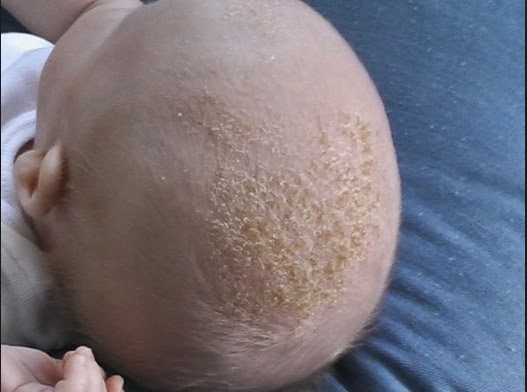 Causes of Infectious Dry Scalp in Infants and Children