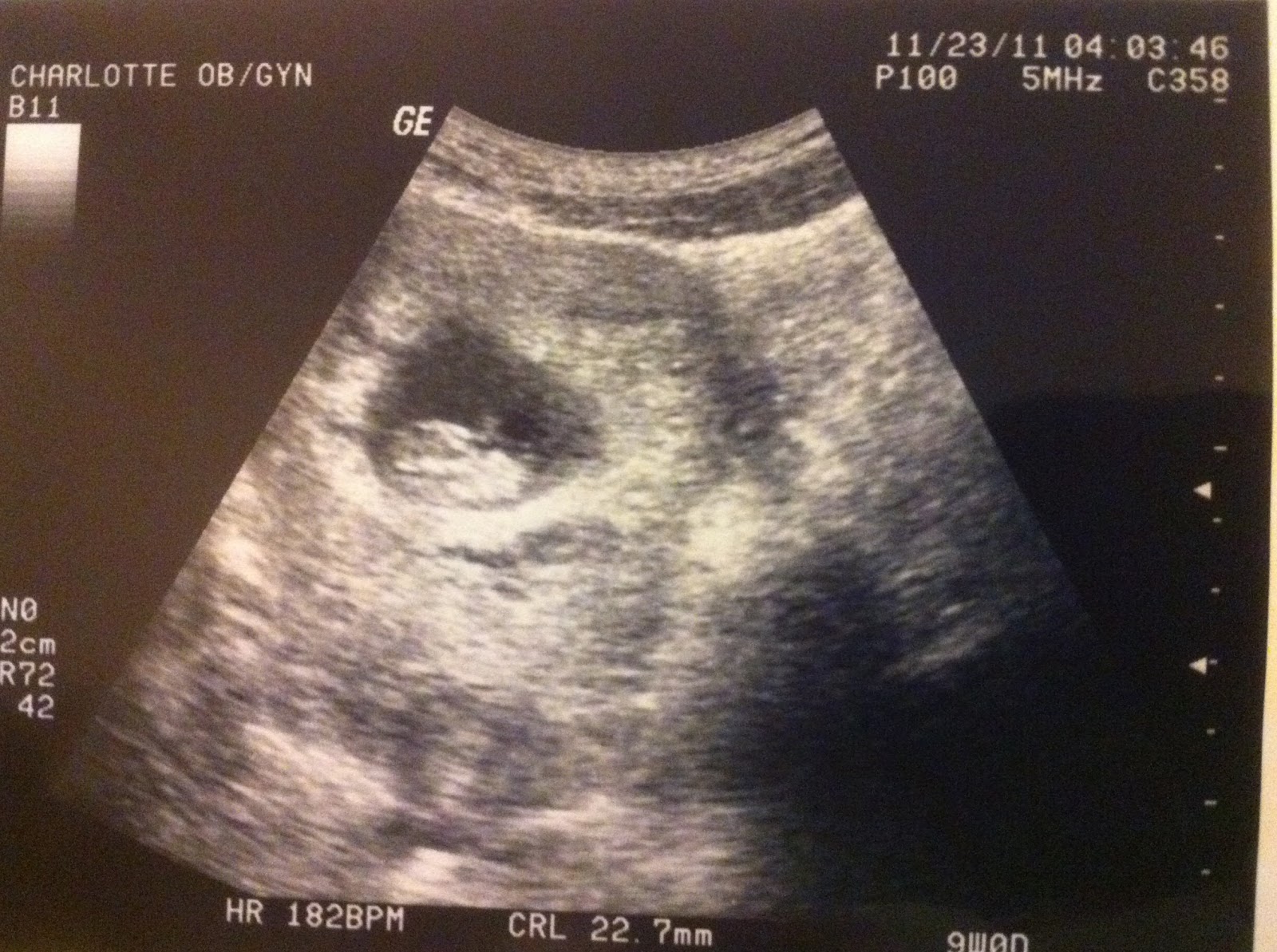 How accurate is conception date by ultrasound