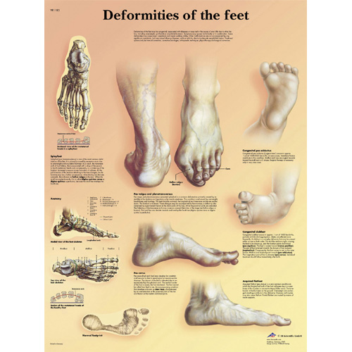 Foot Deformities