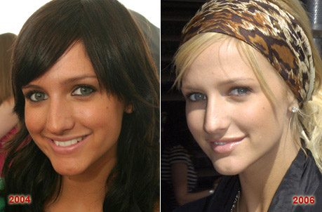 Celebrity Nose Surgery