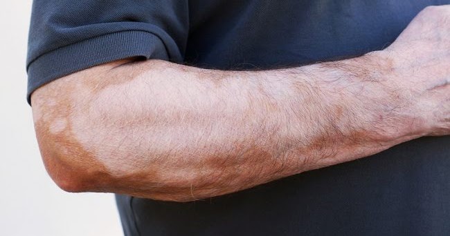 Cara Mengatasi Kulit Belang Seperti Panu | OBAT PENYAKIT KEKURANGAN PIGMEN