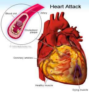 Characteristics of Heart Disease You Need to Know to Stay Healthy