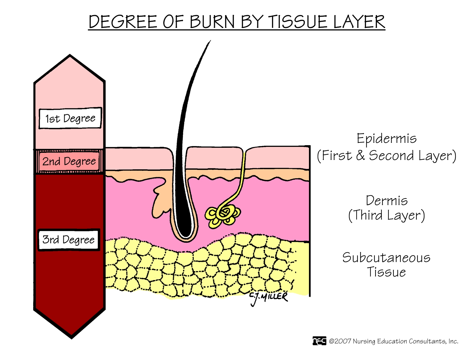 first degree burn pictures first degree burn pictures