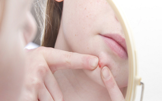How to cure acne chin effectively and sustainably How to cure acne chin effectively and sustainably