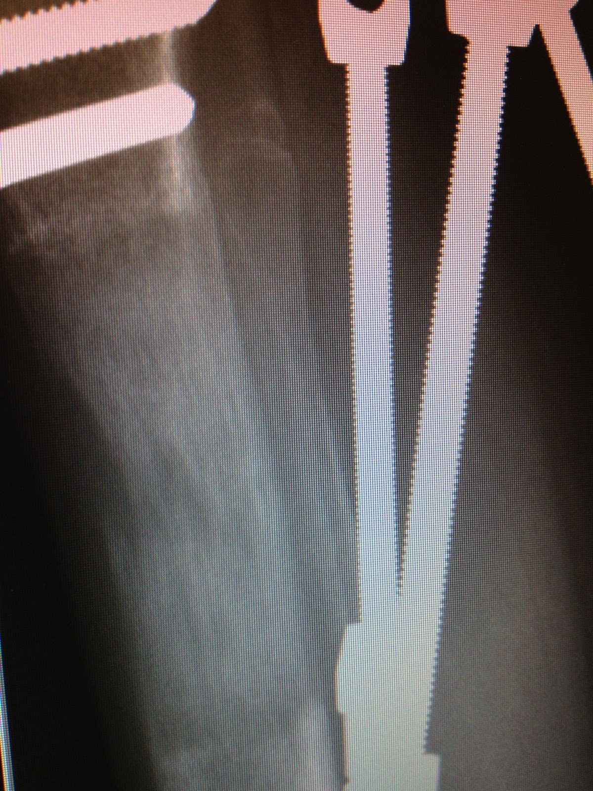 fibular hemimelia leg lengthening Whew! A "dent" vs. a break