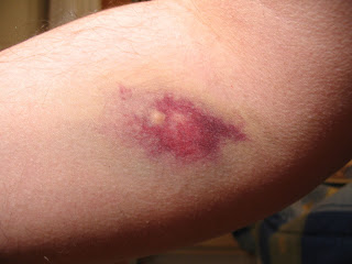 Hematoma Natural Treatment Hematoma Natural Treatment