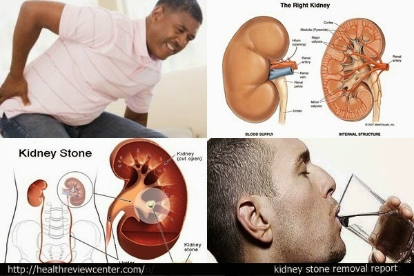 kidney stone lab report Tests to measure kidney function, damage and it may be used to look for abnormalities in size or position of the kidneys or for obstructions such as stones or. kidney stone lab report Tests to measure kidney function, damage and it may be used to look for abnormalities in size or position of the kidneys or for obstructions such as stones or.