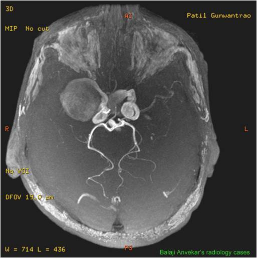 Dr Balaji Anvekar FRCR Bilateral ICA aneurysms MR Angio