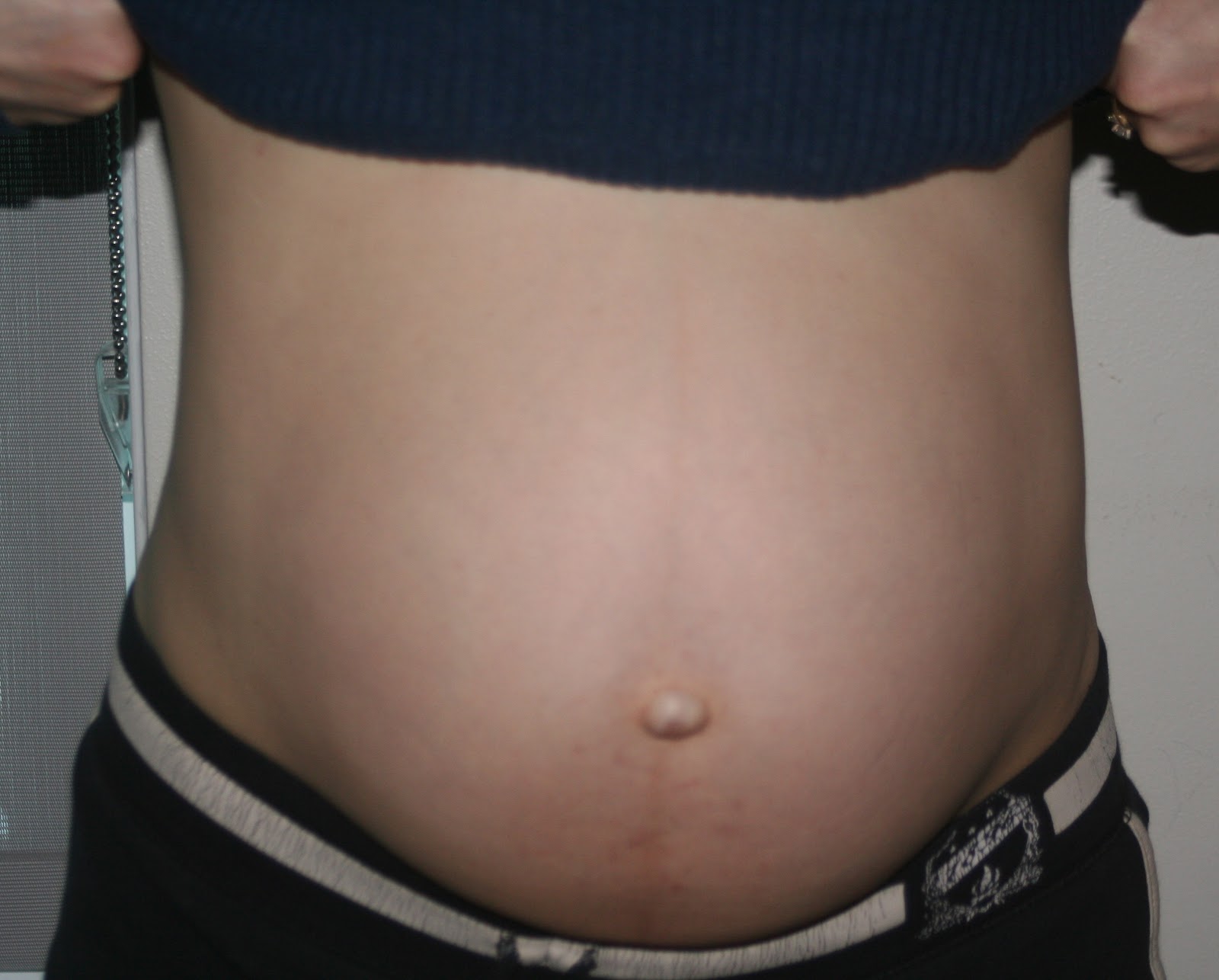 My own Before and After Pics after 5 closing diastasis recti using