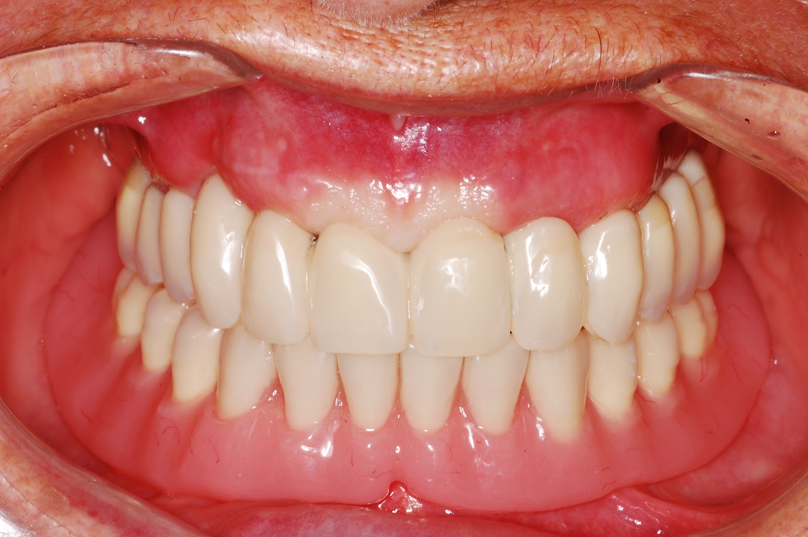 Odontologia Actual: IMPLANTES DENTALES: Preguntas Frecuentes
