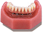 Todo lo que debes saber sobre los implantes dentales 8