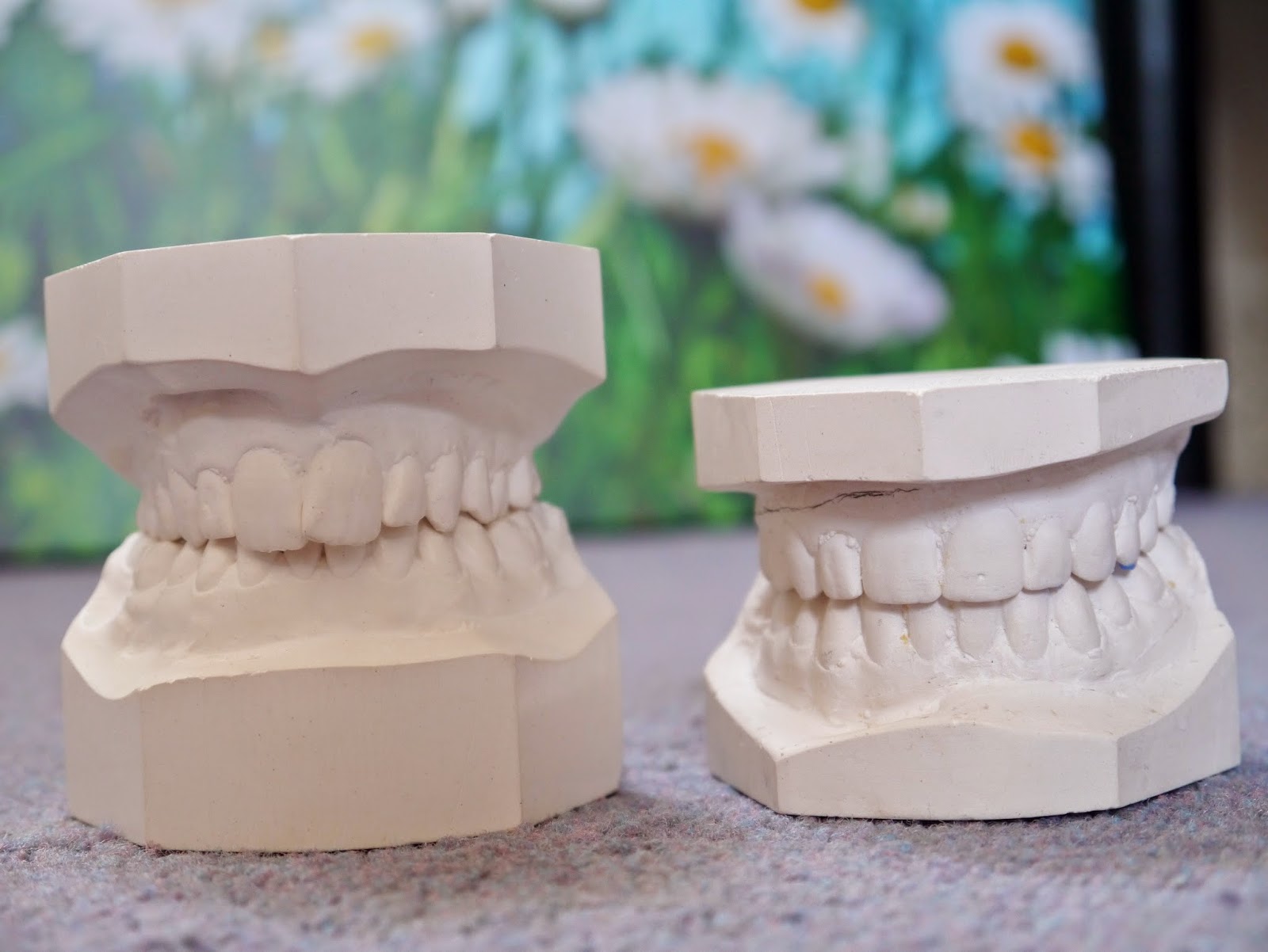 a photo of study models pre and post treatment