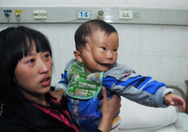 Niño chino nace con extraña "mascara" Ni%25C3%25B1o+de+la+m%25C3%25A1scara