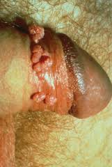 Obat Untuk Membuang Kutil Obat Untuk Membuang Kutil