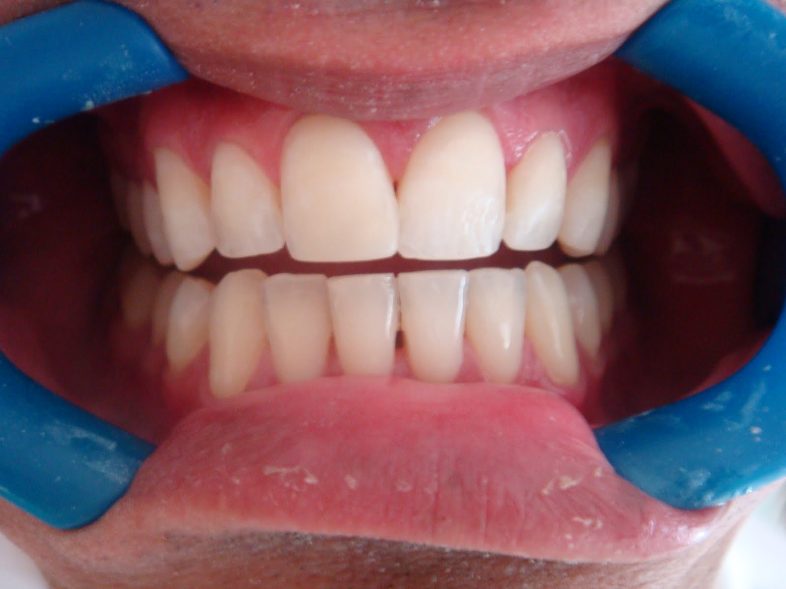 Blog da Dentista: Tratamento estético (clareamento + recuperação de