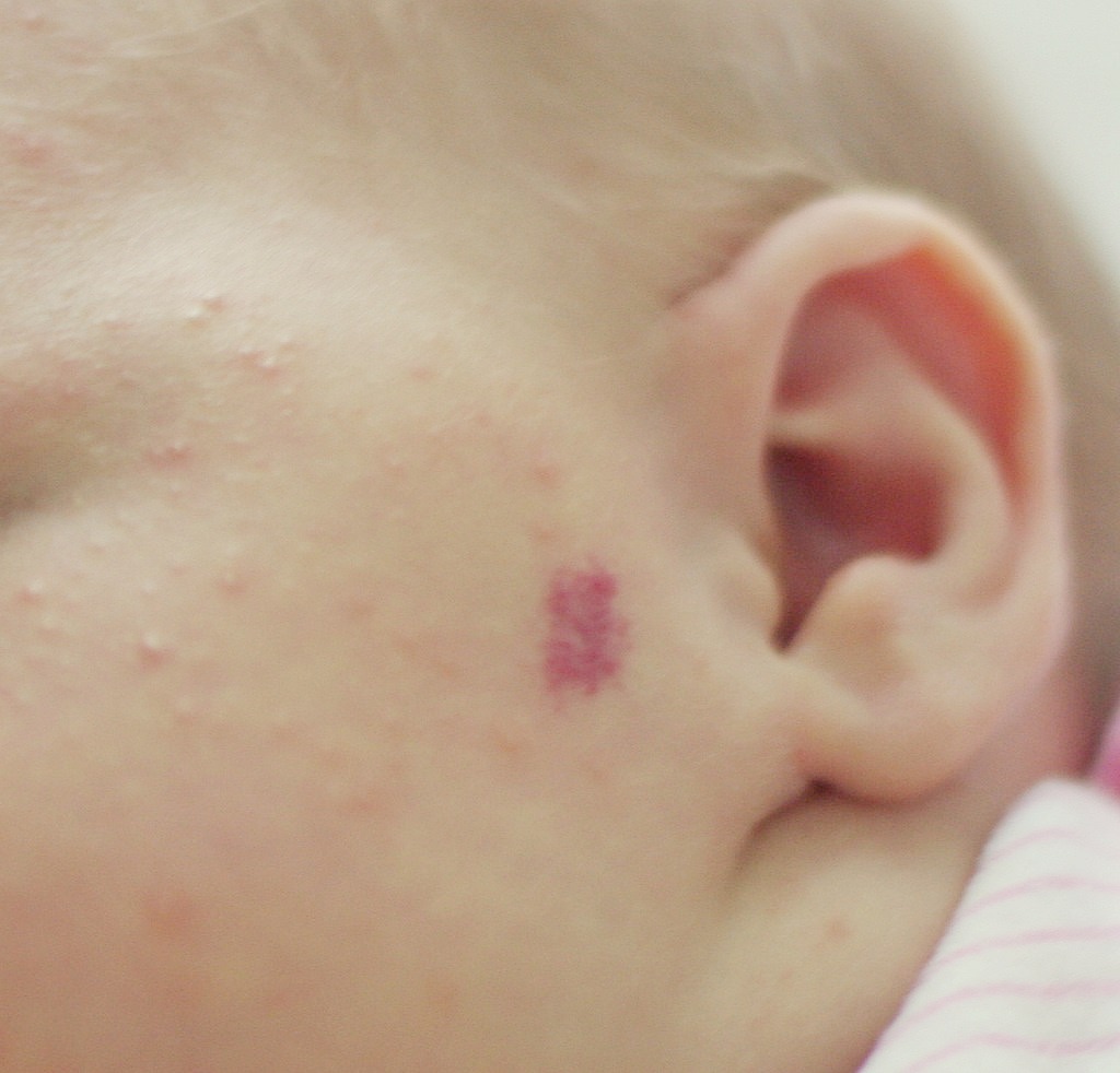 Mortensen Hemangiomas.