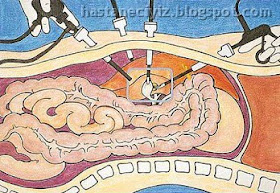 laparoskopi laparoskopi nedir, laparoskopi nasıl yapılır, laparoskopi neden yapılır