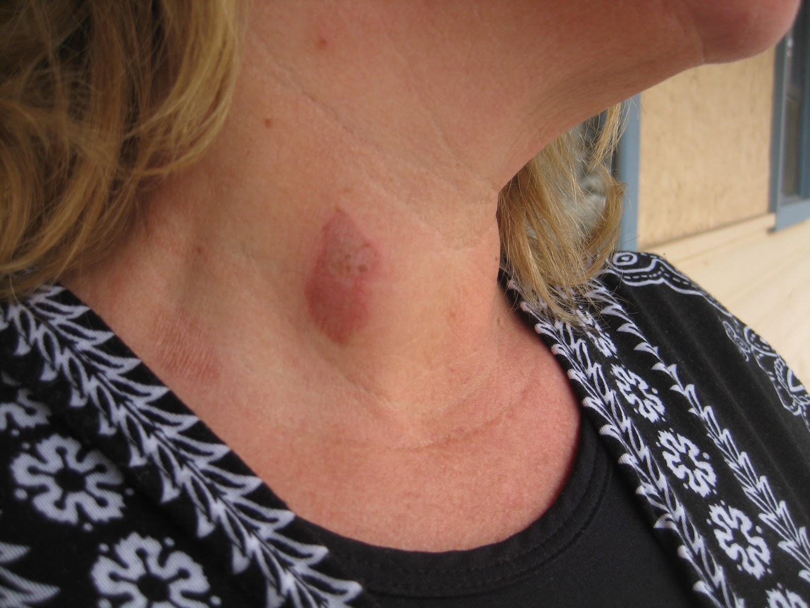 HWWC Tools for Life Fast Acting, Natural FirstAid for Burns