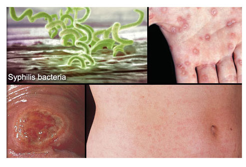 Le psoriasis le stade initial sur la tête