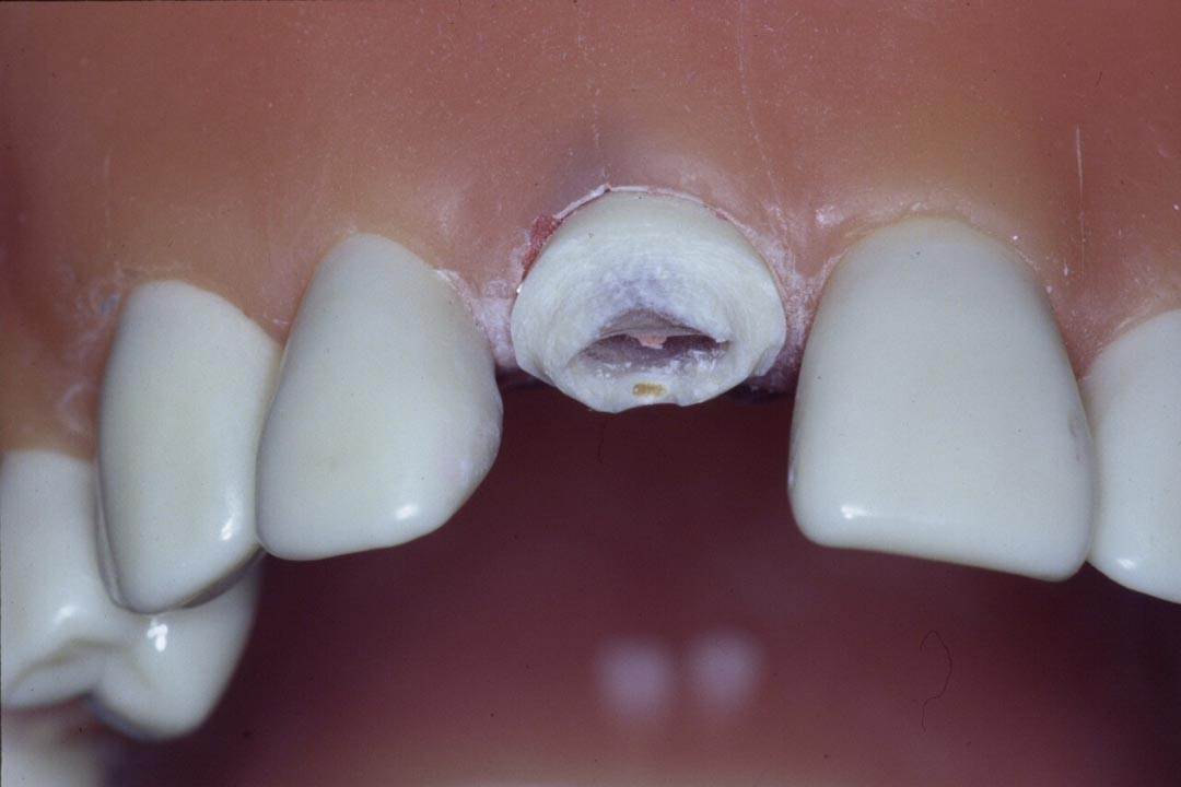 Dentistry Custom Cast Dowel Core