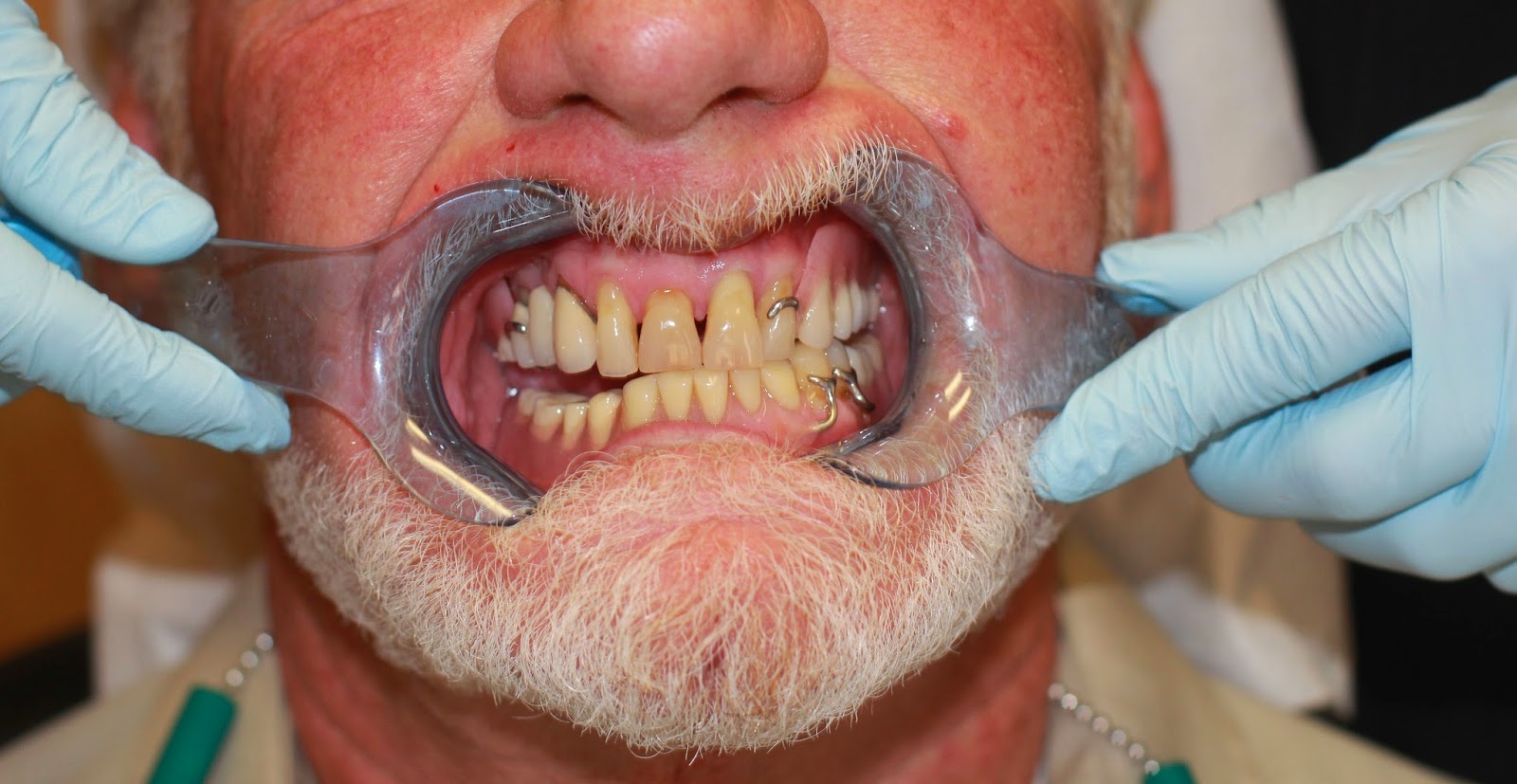 Golpa Dental Implant Center of Las Vegas G4 Implant Solution Dental Implants Las Vegas March