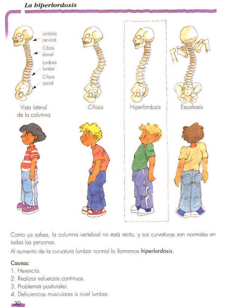Hiperlordosis Lumbar